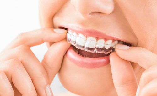 Braces — Align Dental Surgery