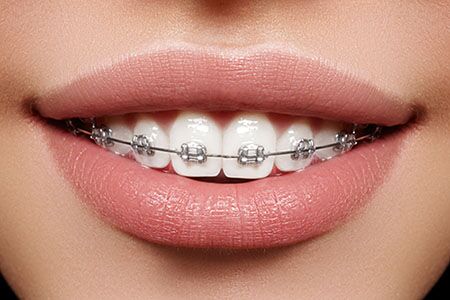 Invisible Braces  How They Work & What They Cost