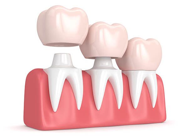 What is a crown in dentistry? • Happy Smile Dental Clinic