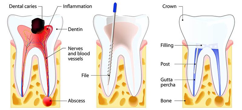 Root Canal Explained - American Association of Endodontists