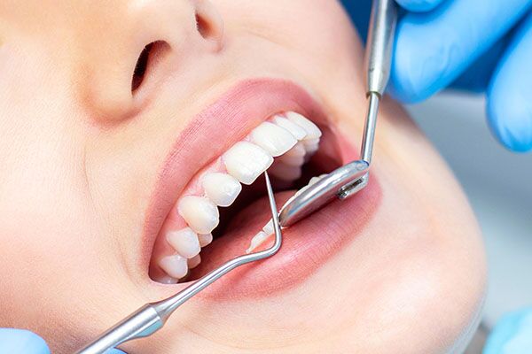 What Do You Need To Know About White Fillings?