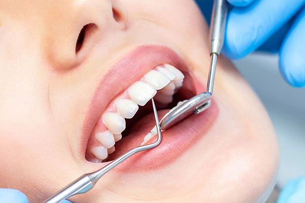 Fillings - DAY AND NIGHT DENTAL