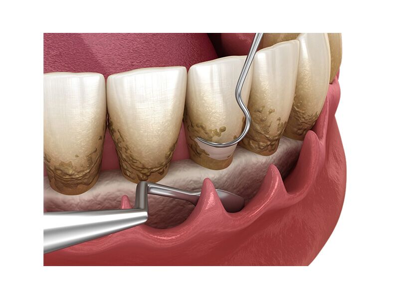 Periodontal Surgery Candidate Treatment Preparation Cost